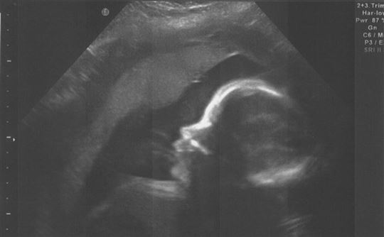 Unborn Child. Flickr